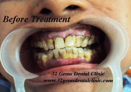 Before Treatment